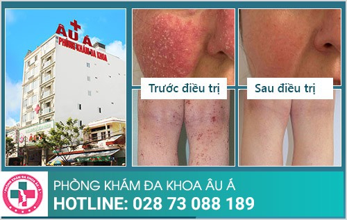 phương pháp điều trị viêm da