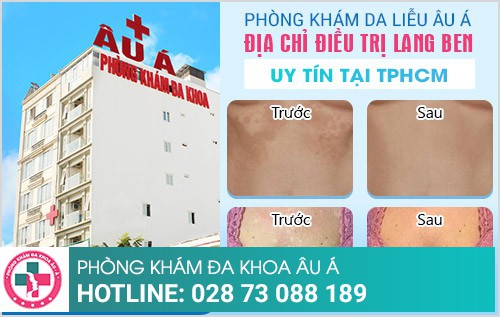 Địa chỉ điều trị lang ben tốt nhất tại TP.HCM