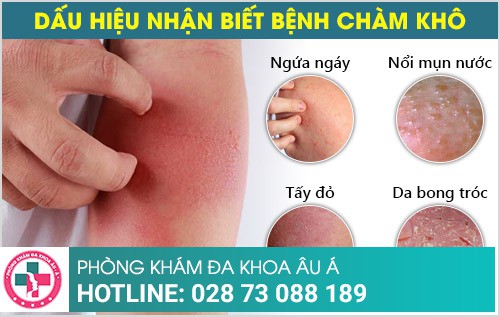 bệnh chàm khô