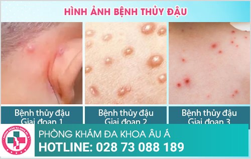 Nhận biết sớm các dấu hiệu của bệnh thủy đậu để điều trị đúng cách