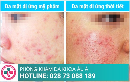Cách trị dị ứng da mặt do mỹ phẩm, thời tiết