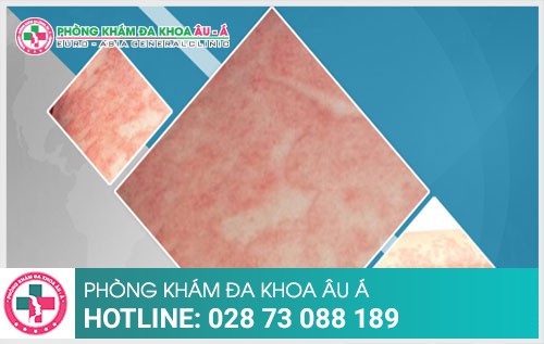 Điều trị bệnh chàm như thế nào nhanh khỏi?