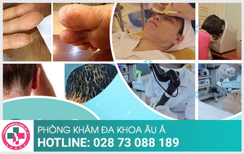 Điều trị bệnh chàm như thế nào nhanh khỏi?