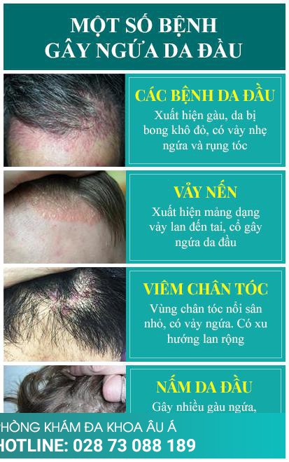 Điều trị các bệnh ngứa da đầu