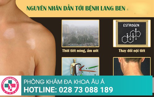 Điều trị lang ben bằng phương pháp tiên tiến