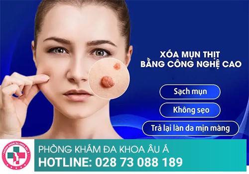 Cách khắc phục bị nổi mụn thịt dư hiệu quả 