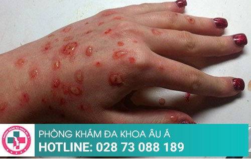 Điều trị thủy đậu tại Phòng Khám Da Liễu Âu Á