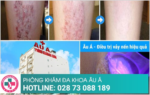 chữa vảy nến ở đâu