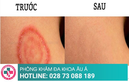 Hắc lào và cách điều trị hắc lào hiệu quả