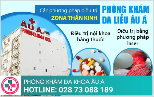 zona ở mắt