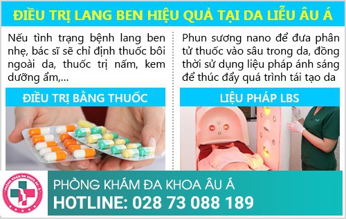 cách trị lang ben hiệu quả