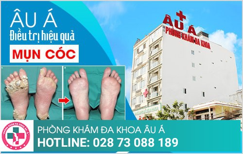 bắn laser mụn cóc