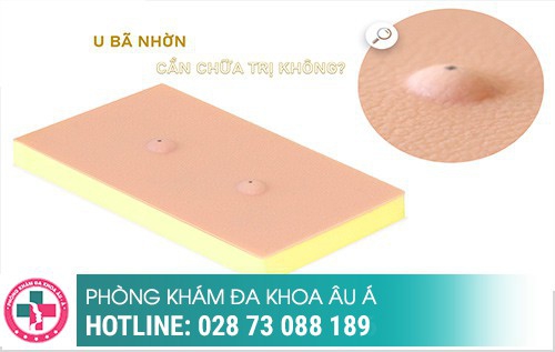 Tổng quan về u nang bã nhờn, nguyên nhân và cách điều trị