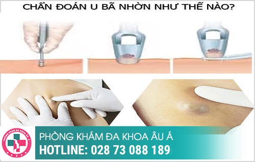 Tổng quan về u nang bã nhờn, nguyên nhân và cách điều trị