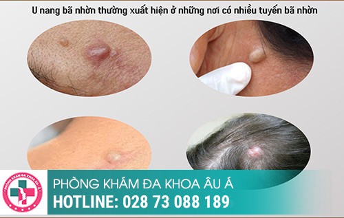 Tổng quan về u nang bã nhờn, nguyên nhân và cách điều trị