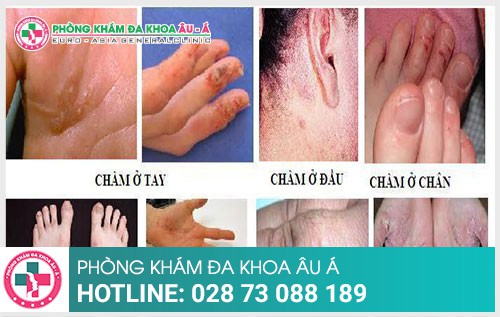 Kiêng ăn gì khi bị bệnh chàm để nhanh khỏi - Phòng Khám Đa Khoa Âu Á