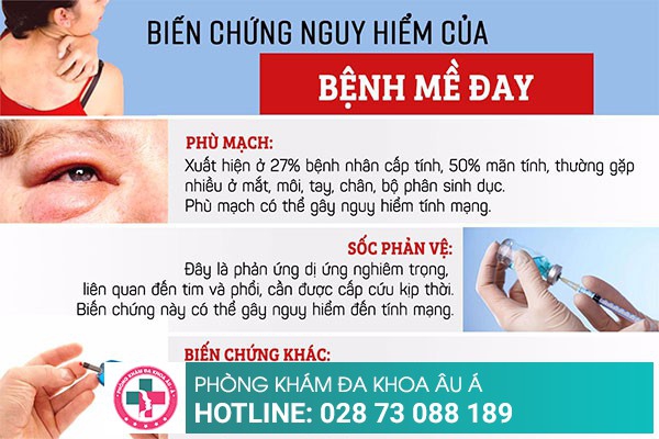 Mẩn đỏ ngứa buổi tối là biểu hiện bệnh gì?