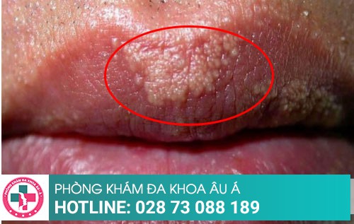 Môi nổi hạt trắng nhỏ là biểu hiện của bệnh gì?
