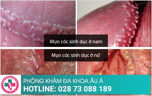 mụn cóc