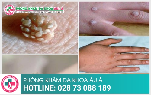 Mụn cơm và những điều bạn chưa biết?