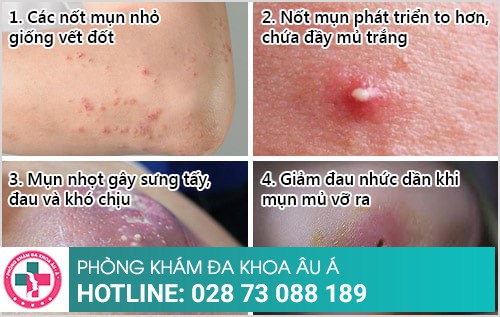 Dấu hiệu bị mụn nhọt tay, chân