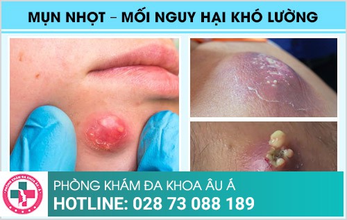 Phương pháp chữa mụn nhọt