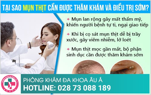 Mụn thịt và giải pháp hỗ trợ điều trị hiệu quả