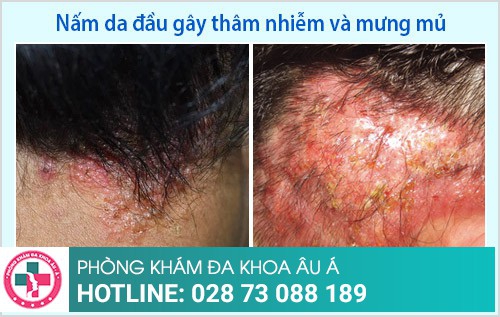 điều trị nấm da đầu