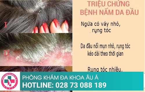 Nấm da đầu cách trị tốt nhất và hiệu quả