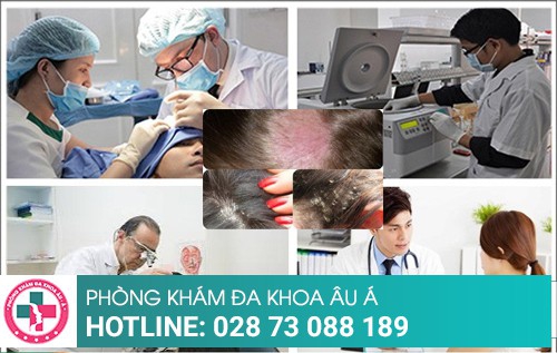 Nấm da đầu cách trị tốt nhất và hiệu quả