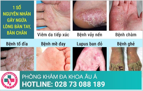 ngứa lòng bàn tay bàn chân