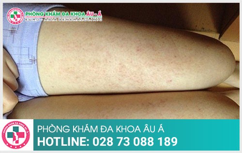 Nguyên nhân bệnh dày sừng nang lông là gì?
