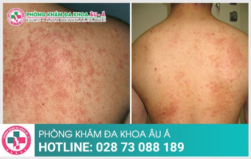 Nguyên nhân không ngờ khiến bạn bị chàm - Phòng Khám Đa Khoa Âu Á