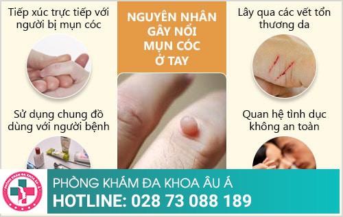 mụn cóc ở tay