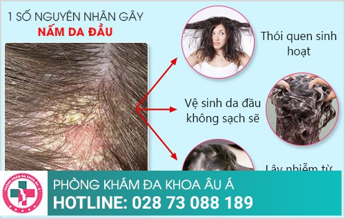 Cách chữa nấm da đầu hiệu quả chỉ trong 1 liệu trình