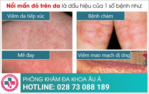 Nổi mẩn đỏ trên da