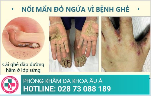 Da nổi mẩn đỏ ngứa