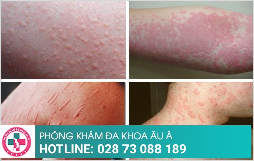 Nổi mề đay