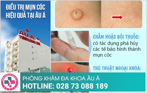 mụn cóc ở tay