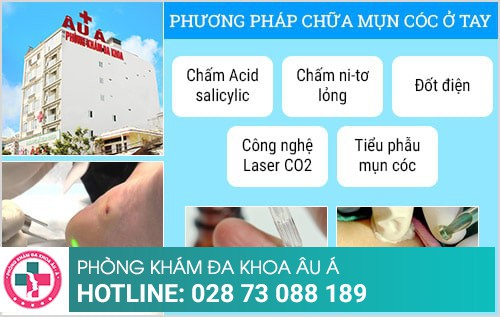 mụn cóc ở tay