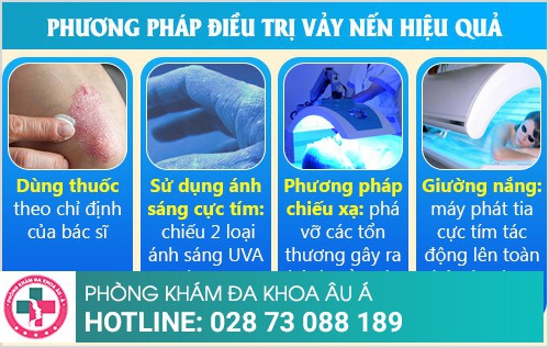 bệnh vảy nến