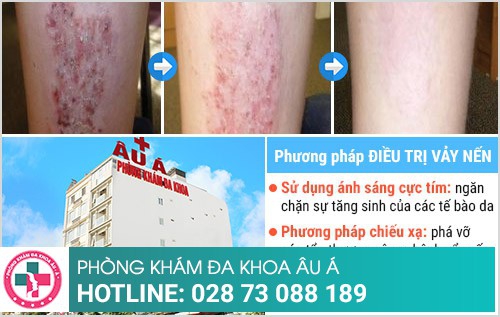 Bệnh vảy nến và những thông tin cần biết