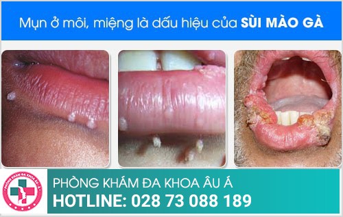 Nổi mụn quanh miệng