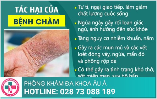 chữa bệnh chàm