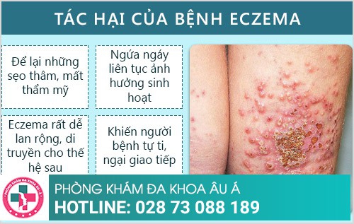 bệnh eczema