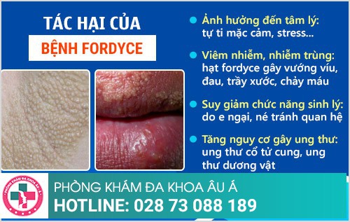 Bệnh fordyce