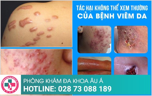 Địa chỉ chữa bệnh viêm da uy tín tại TP.HCM