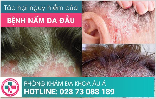 dấu hiệu nấm da đầu