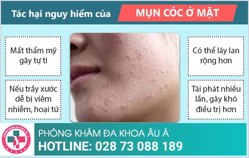 Mụn cóc ở mặt: Dấu hiệu và cách điều trị