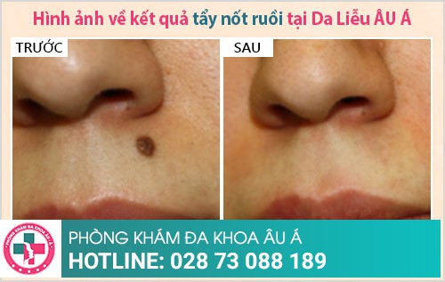 địa chỉ phá nốt ruồi